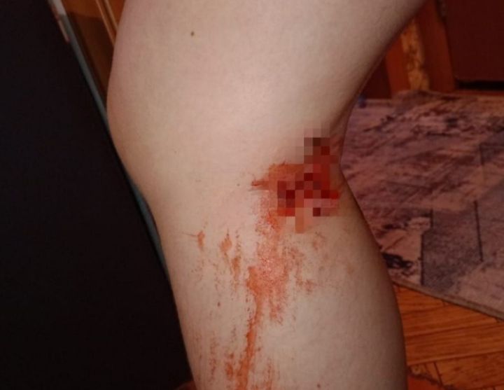 Собаки вскоре после нападения на женщин в Киселевске атаковали идущего в школу ребенка 