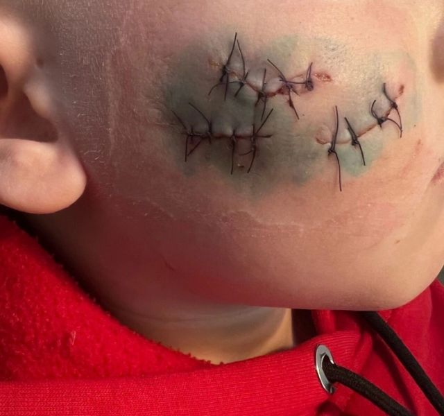 Ребенок попал в больницу с рваными ранами лица после нападения собаки в Кузбассе